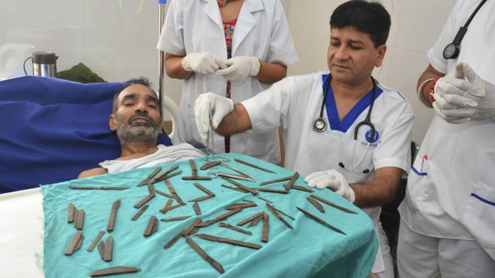 Pria India ini Telan 40 Pisau Selama 3 Bulan, Dokter Berhasil Mengambilnya