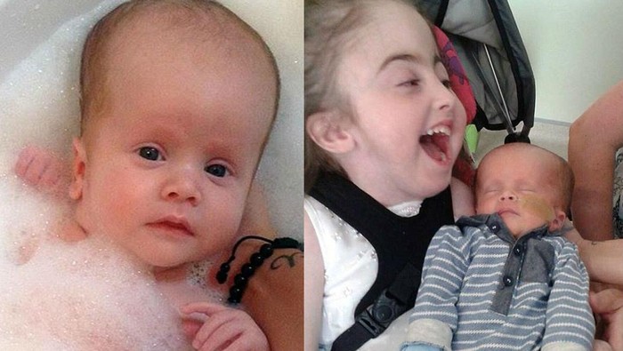 Kisah Reuben yang Sama-sama Alami Cacat Langka Seperti Bibinya