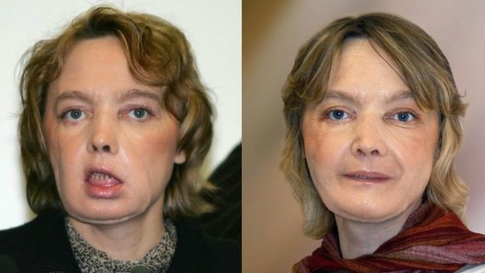 Penerima Transplantasi Wajah Pertama Meninggal Dunia