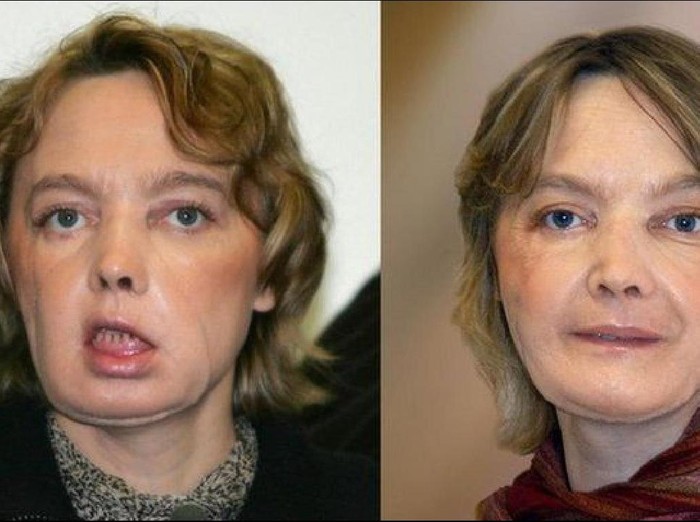 Pasien Transplantasi Wajah Pertama di Dunia Meninggal karena Kanker