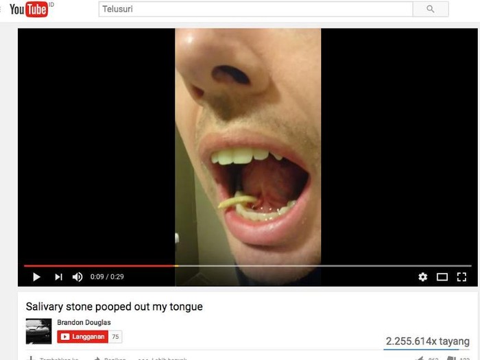 Hii, Ada Batu Kelenjar Ludah di Mulut Pria Ini