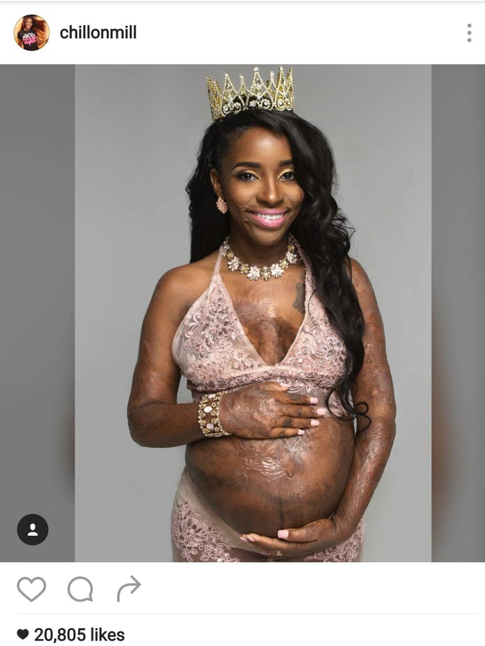 Foto-foto Inspiratif Ibu Hamil yang Pernah Alami Luka Bakar Parah