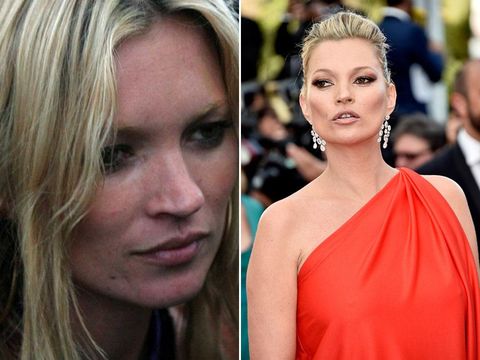 7 Selebriti yang Menutupi Jerawat dengan Makeup