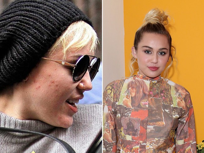 Miley Cyrus mengakui bahwa jerawatnya membuat dia insecure. Untuk menjalani karier sebagai public figure, Miley berusaha menutupi ketidaksempurnannya itu dengan concealer dan foundation. Ia pun tetap berusaha menjalani gaya hidup sehat dengan tidak makan dan minum yang dapat memicu jerawat. Foto: istimewa