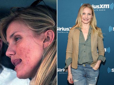 7 Selebriti yang Menutupi Jerawat dengan Makeup