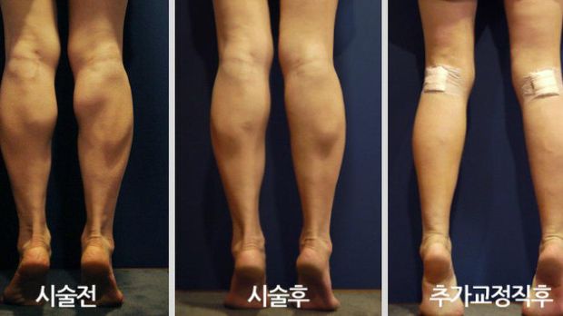 10 Prosedur Kecantikan yang Aneh dan Tak Biasa di Korea Selatan