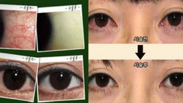 10 Prosedur Kecantikan yang Aneh dan Tak Biasa di Korea Selatan