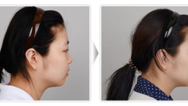 10 Prosedur Kecantikan yang Aneh dan Tak Biasa di Korea Selatan