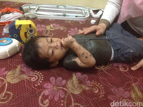 Seluruh Tubuh Hampir Tertutup Bercak Hitam, Balita Ini Tetap Lincah dan Ceria
