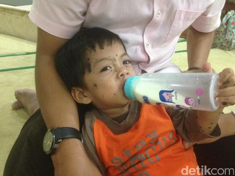 Seluruh Tubuh Hampir Tertutup Bercak Hitam, Balita Ini Tetap Lincah dan Ceria