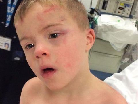 Masuk ke Mesin Pengering, Anak dengan Down Syndrome Ini Diselamatkan Anjingnya