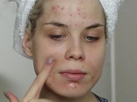 Wajah Berjerawat, Vlogger Kecantikan Ini Di-Bully Mirip Lumut Hingga Badut