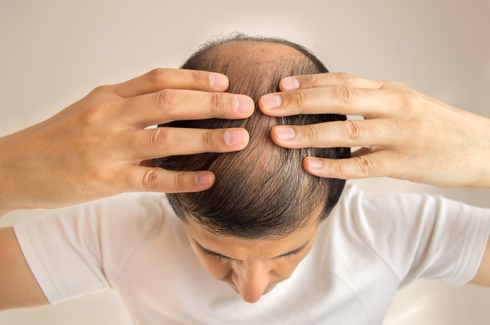 Ilustrasi Rambut Rontok, Kebotakan, Hair Loss