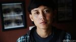 Kembalikan Percaya Diri Dengan Mata Palsu
