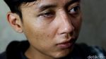 Kembalikan Percaya Diri Dengan Mata Palsu