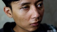 Seorang pasien mengalami cacat mata disebelah kanan.