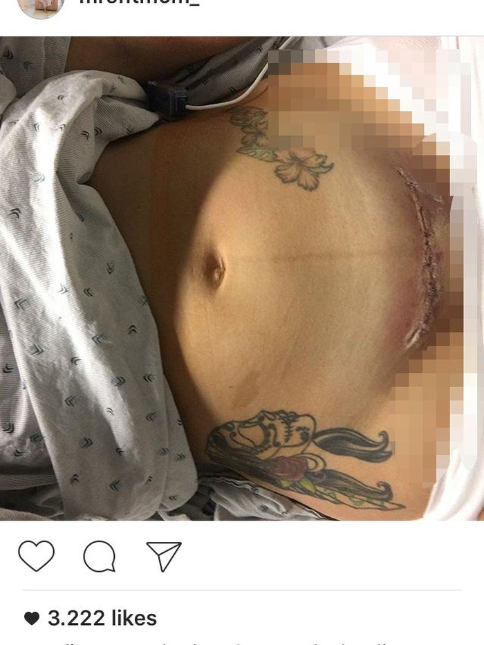 Cerita di Balik Foto Luka Caesar Seorang Ibu yang Jadi Viral