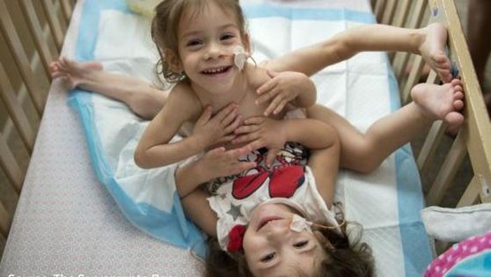 Jalani Operasi 18 Jam, Bocah Kembar Siam Ini Akhirnya Dipisahkan