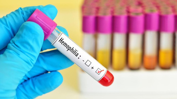 Pada pengidap hemofilia, perdarahan sulit dihentikan (Foto: ilustrasi/thinkstock) Pada pengidap hemofilia, perdarahan sulit dihentikan (Foto: ilustrasi/thinkstock)