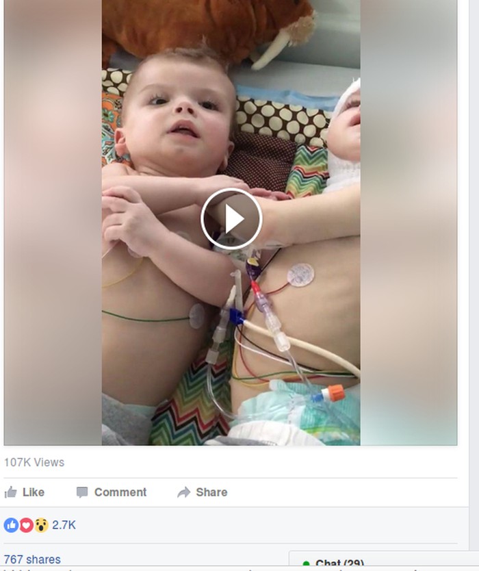 Momen Haru Saat Kembar Dempet Kepala Bisa Saling Pandang Ini Jadi Viral