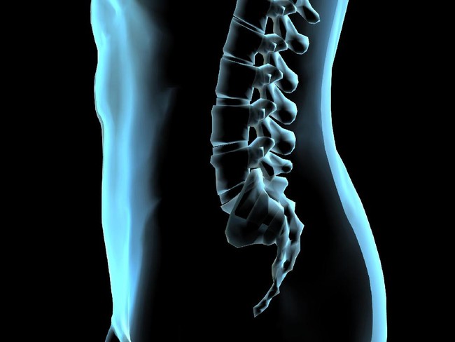 4 Faktor Risiko Pendorong Kejadian Saraf Terjepit