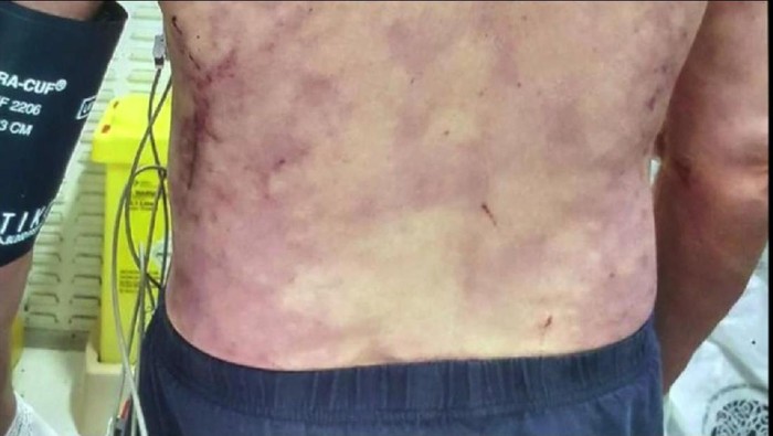 Kena Infeksi Langka dari Liur Anjing, David Koma Sampai 6 Minggu