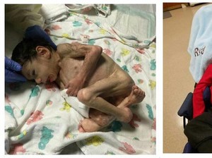 Kisah Bayi Malnutrisi yang Kini Lucu dan Menggemaskan Setelah Diadopsi