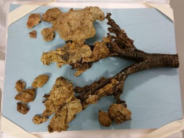 Setelah 200 Tahun Lebih, Dokter Akhirnya Mengonfirmasi Penyakit Pasien Ini