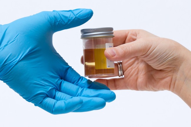 Saat Urine Tercium Tak Biasa, Mungkin 6 Hal Ini Penyebabnya