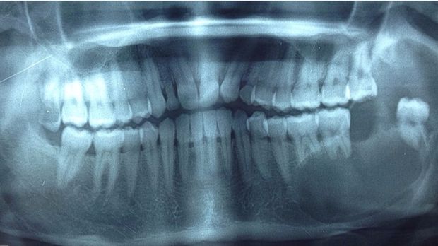 Ameloblastoma, si Pemakan Rahang