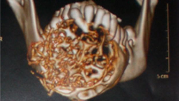 Ameloblastoma, si Pemakan Rahang