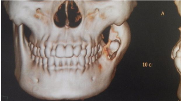 Ameloblastoma, si Pemakan Rahang