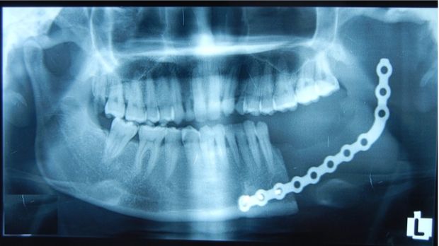 Ameloblastoma, si Pemakan Rahang