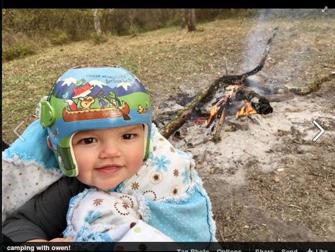 Lucunya Anak-anak Ini Meski Pakai Helm Korektif untuk Tengkoraknya
