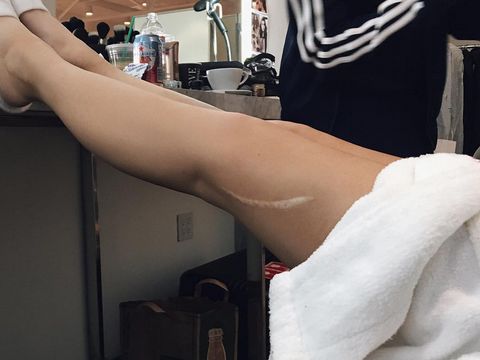 Foto: Ketika Kylie Jenner Pamer Bekas Luka di Pahanya 