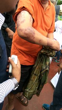  Kisah Korban Bom Thamrin Ipda Denny dan Sakit yang Dideritanya