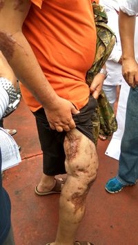  Kisah Korban Bom Thamrin Ipda Denny dan Sakit yang Dideritanya