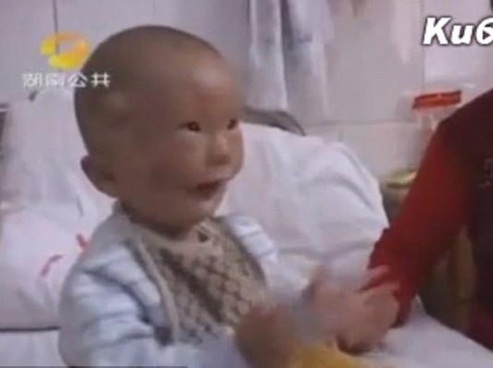 Cacat Lahir Langka, Wajah Bocah Ini Seperti Pakai Topeng