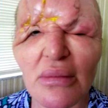 Salah Suntik Filler, Dahi Carol 'Meleleh' dan Menonjol Seperti Alien