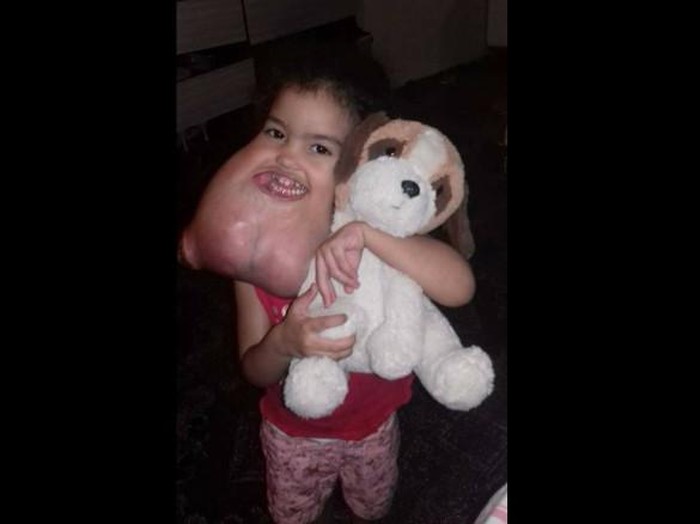 Akhirnya Tumor 2 Kg di Wajah Bocah Ini Berhasil Diangkat