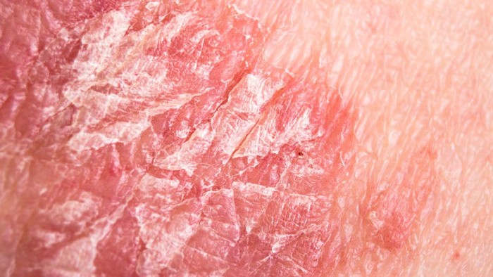 penyakit kulit psoriasis apakah menular