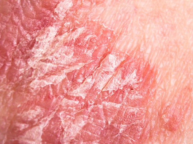 5 Fakta Psoriasis, Kondisi Kulit yang Diidap Indadari