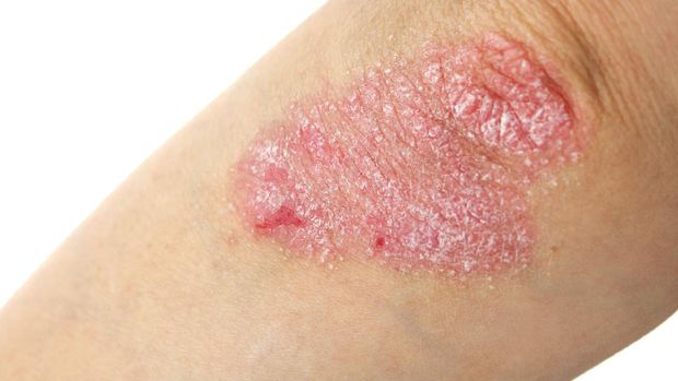 Psoriasis dapat dilihat dari bentuk kuku