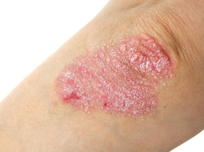 Kim Kardashian Hingga Indadari, Para Pesohor yang Kena Psoriasis