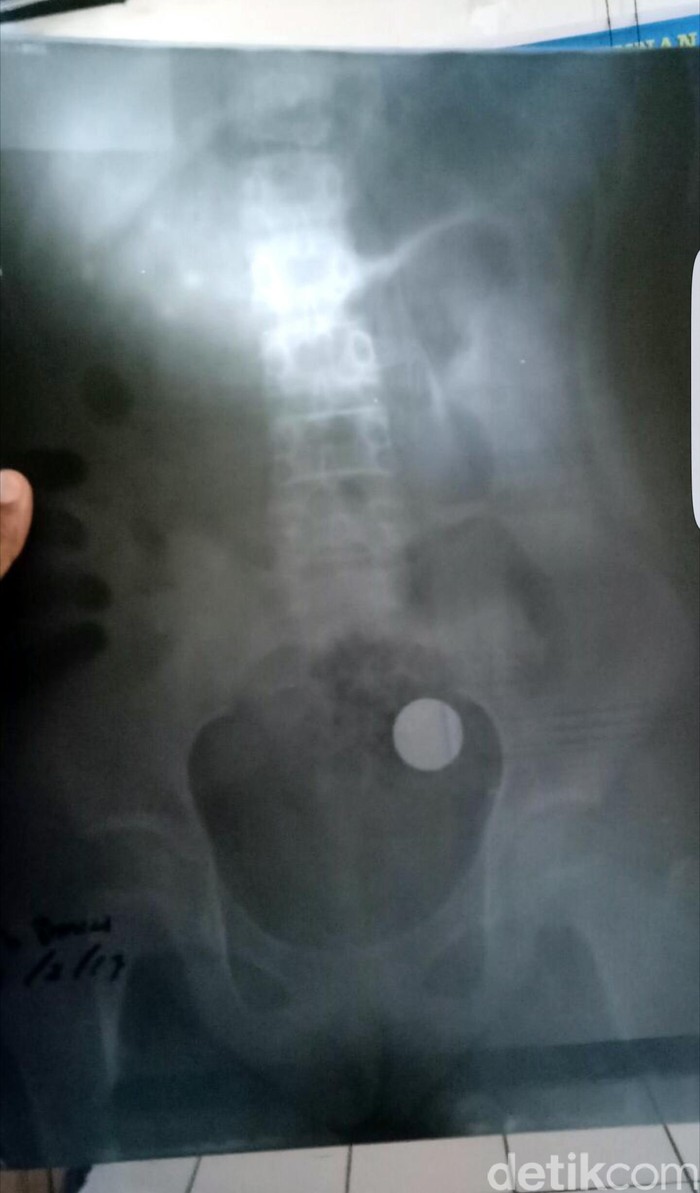 Selama 4 Tahun Koin Rp 500 Menempel di Usus Dania Asal Sukabumi