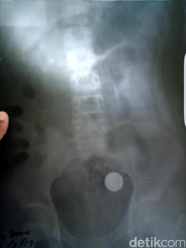 Benda-benda Ini Sering Tertelan dan Terjebak Lama di Tubuh Manusia