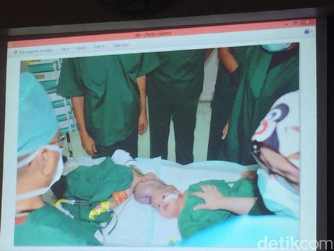 Bayi kembar siam Rifky dan Rafky