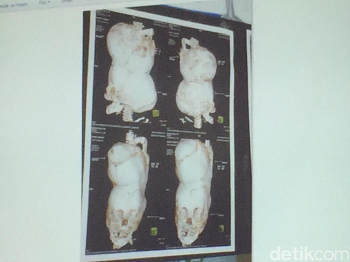 Cerita Sukses Pemisahan Kembar Siam Dempet Kepala Rifky-Rafky