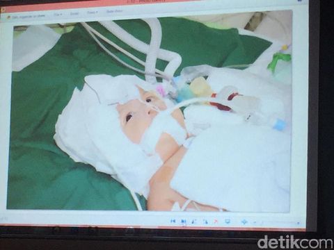  Kembar siam Rifky dan Rafky berhasil dipisahkanKembar siam Rifky dan Rafky berhasil dipisahkan Foto: An Uyung P
