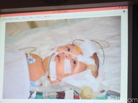 Kembar siam Rifky dan Rafky berhasil dipisahkan